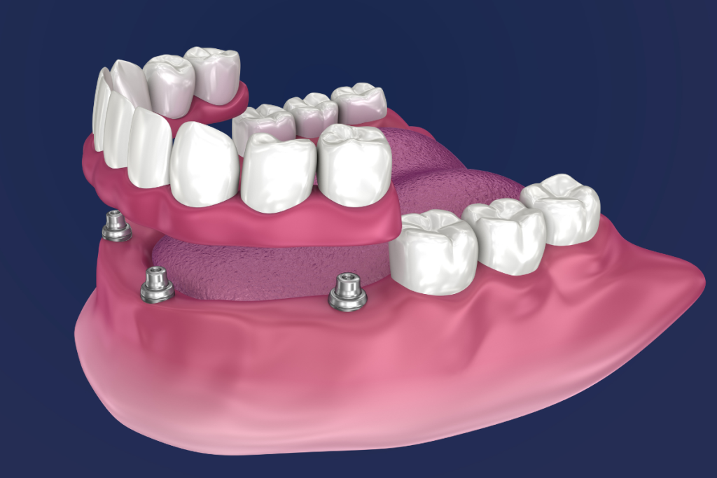 all-on-4 implantátum