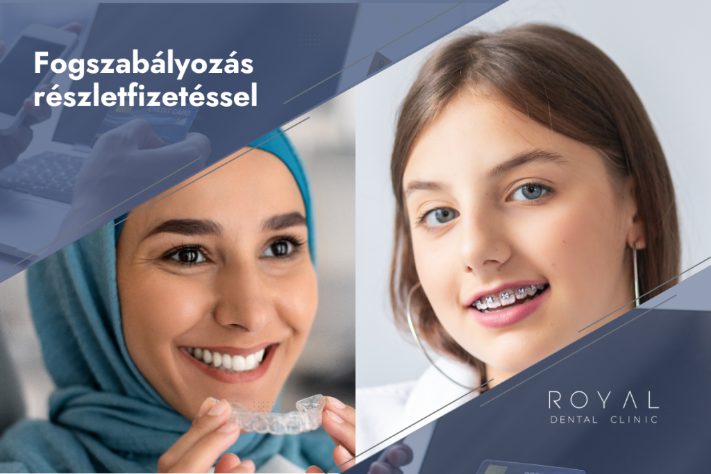 Fogszabályozás részletfizetéssel