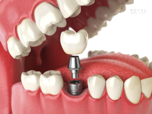 Implantátum felépítmény