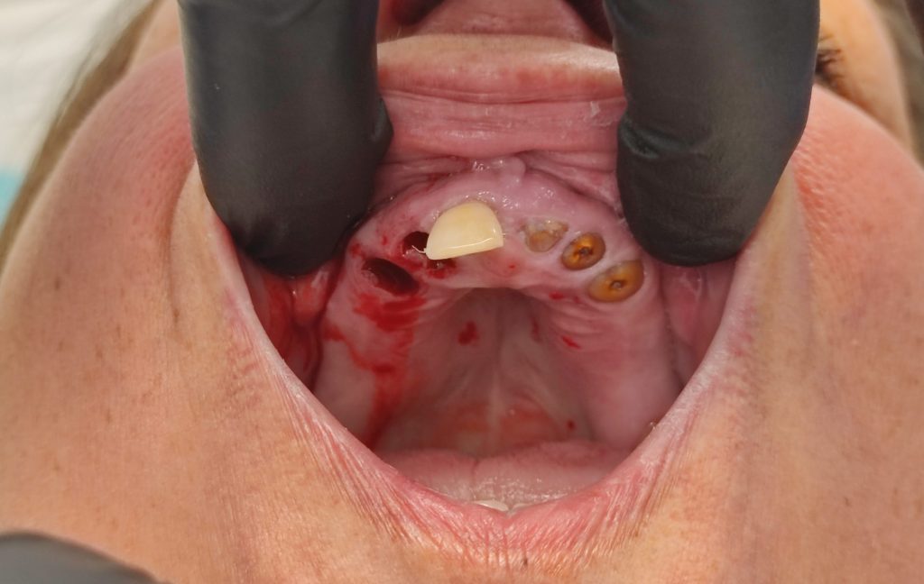 Kezdő állapot: teljes foghiány menthetetlen fogakkal