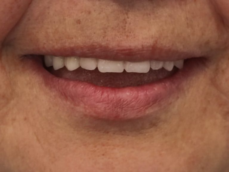 Végleges kerámia all-on-4 fogpótlás 1 év elteltével