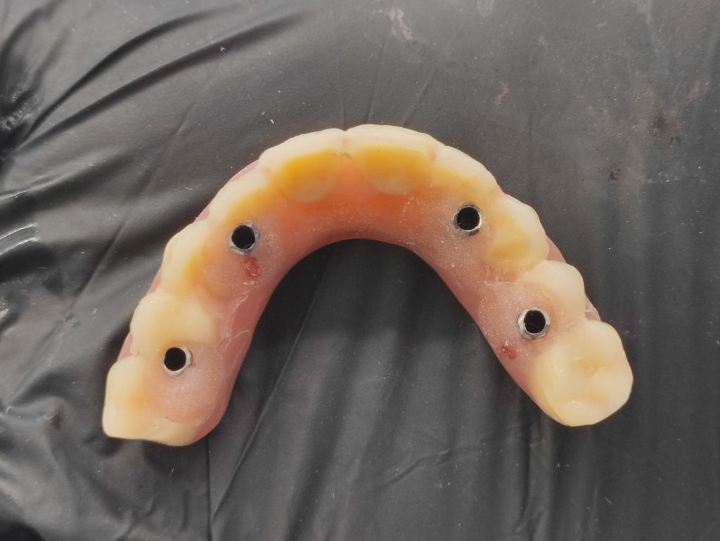 Azonnali ideiglenes fogpótlás felülnézetből