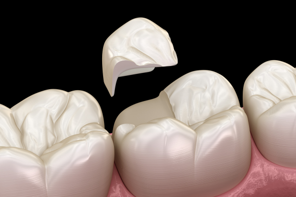 Onlay betét fogpótlás