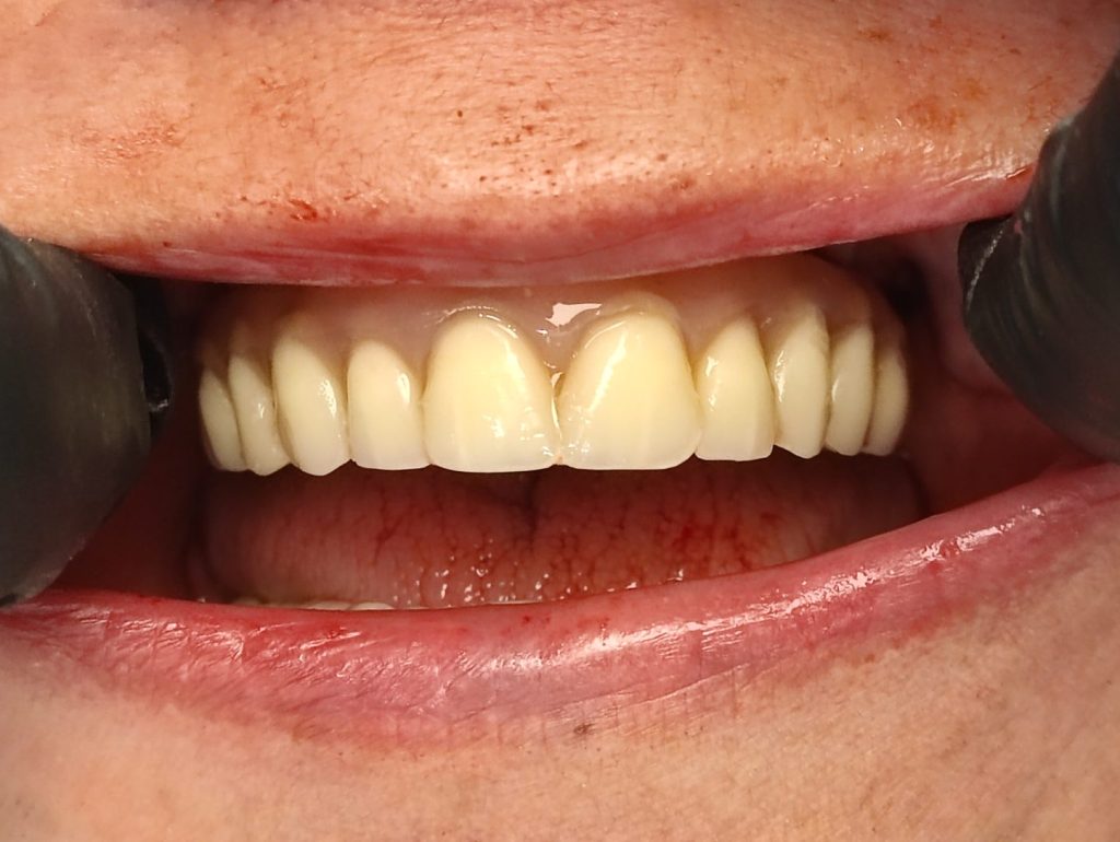 Azonnali ideiglenes fix fogpótlás