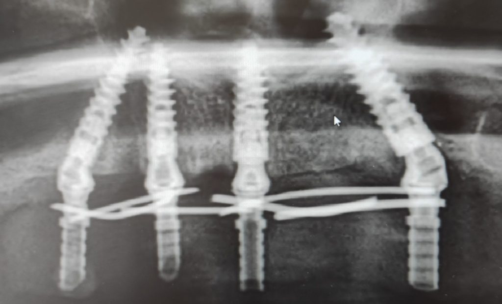 Implantátumok felhelyezéséről röntgen