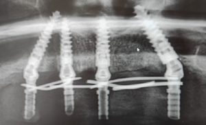 Implantátumok felhelyezéséről röntgen