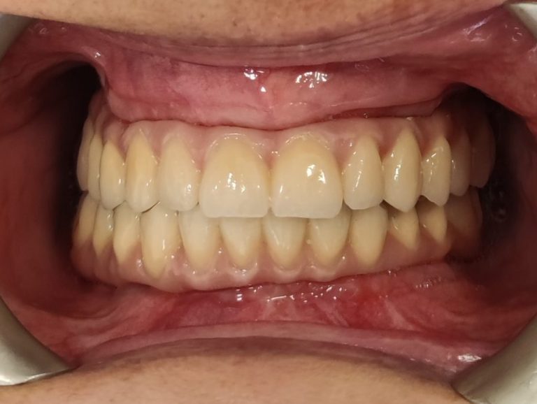 Végleges kerámia all-on-4 fix fogpótlás 3 hónapos kontroll után