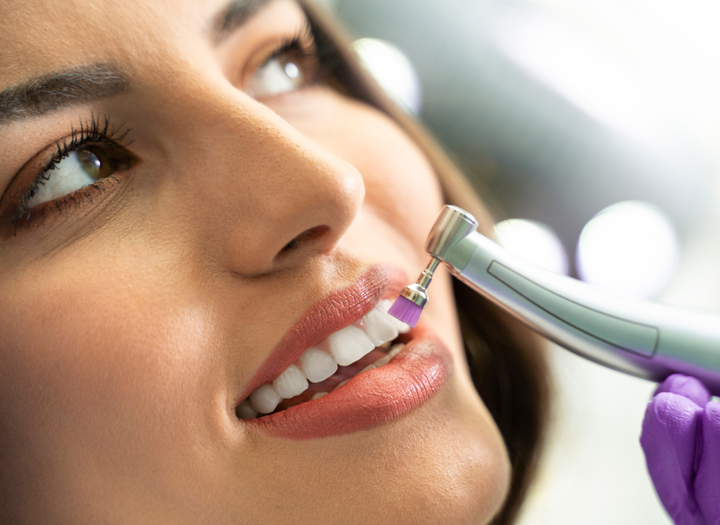 Fogkő eltávolítás utáni polírozás