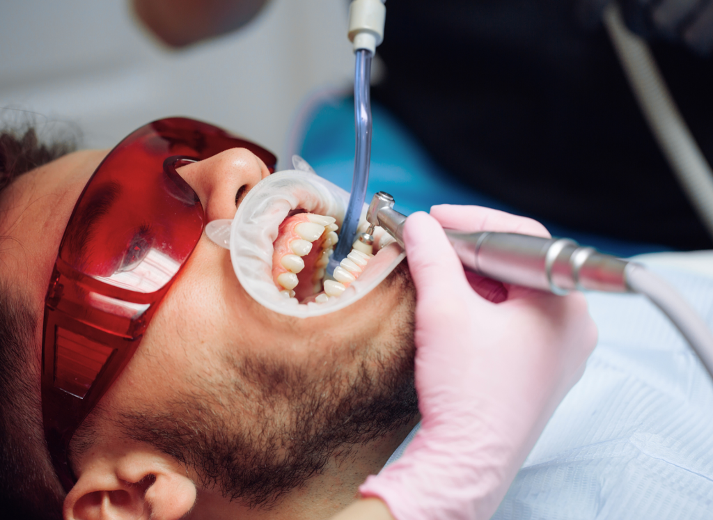 Fogkő-eltávolítási kezelés