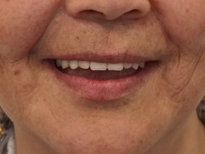 Fogászati implantáció Budapest